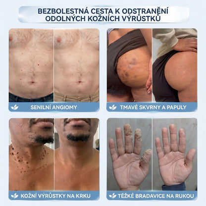 𝐇𝐢𝐬𝐤𝐢𝐧® 2-in-1 Pokročilý bezbolestný krém pro péči o pokožku bez viditelných stop – pro kožní výrůstky, bradavice a viditelné nedokonalosti pokožky