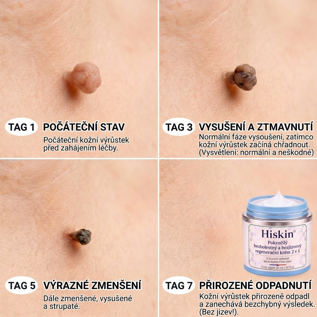 𝐇𝐢𝐬𝐤𝐢𝐧® 2-in-1 Pokročilý bezbolestný krém pro péči o pokožku bez viditelných stop – pro kožní výrůstky, bradavice a viditelné nedokonalosti pokožky